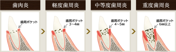 歯肉炎→軽度歯周炎→中等度歯周炎→重度歯周炎